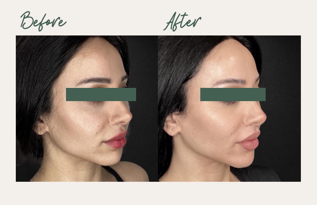 Full Face Sculptra