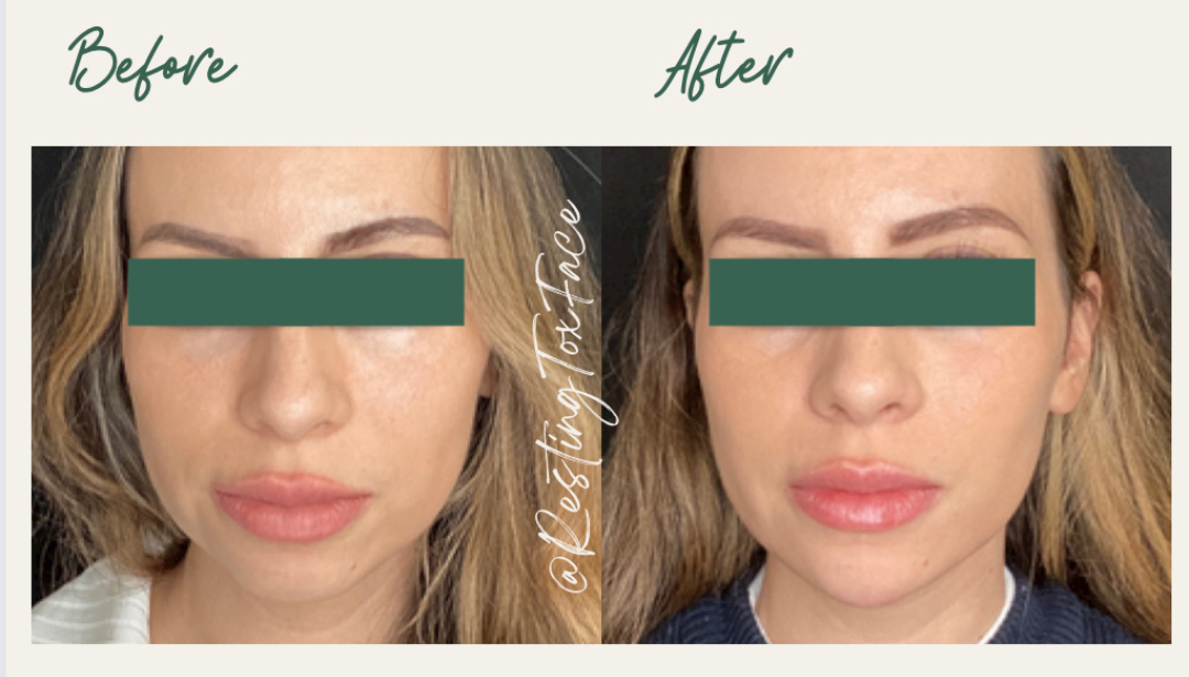 Chin Filler
