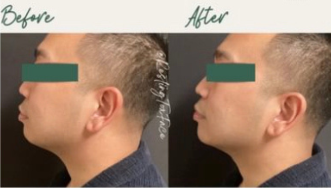 Chin Filler