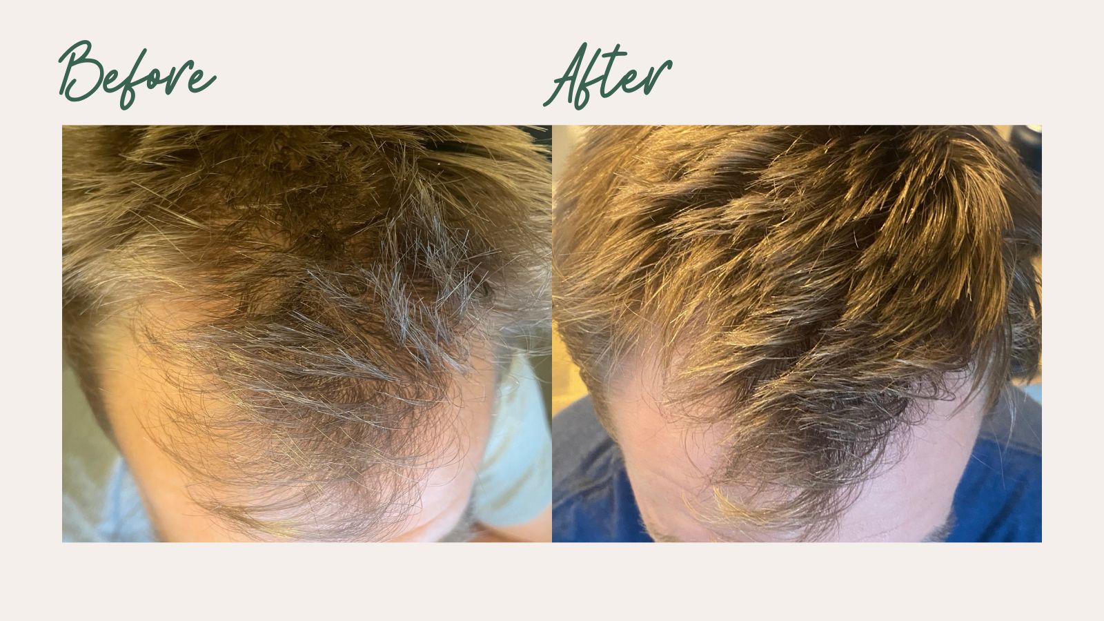 Hair Growth Progress
